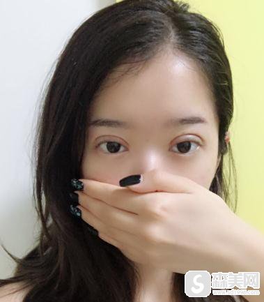 北京华美做的埋线双眼皮怎么样？附案例前后对比照片