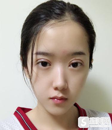 北京华美做的埋线双眼皮怎么样？附案例前后对比照片