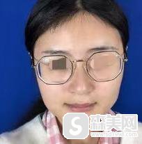 重庆华美整形医院怎么样？附下颌角案例分享+案例果图