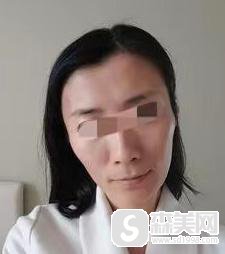 北京冯斌脂肪填充手术怎么样?附脂肪填充案例分享