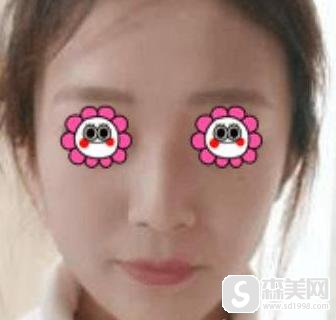 上海时光整形医院隆下巴手术怎么样？附隆下巴案例