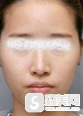 柳州人民医院怎么样？光子嫩肤的果怎么样？附案例分享＋前后果对比图