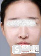 柳州人民医院怎么样?光子嫩肤的果怎么样?附案例分享+前后果对比图