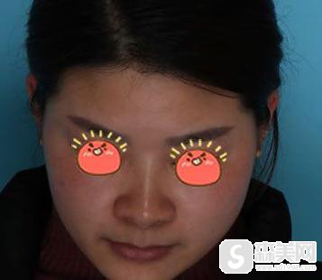 北京海医悦美医院林勇医生隆鼻怎么样?附隆鼻案例+案例对比图