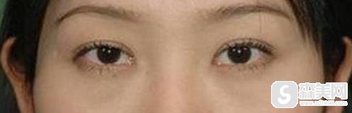 郑楚蓉医生口碑怎么样?北京上上相整形美容医院怎么样?附双眼皮手术案例