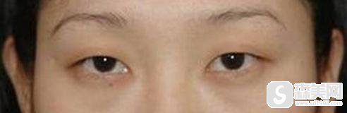 郑楚蓉医生口碑怎么样?北京上上相整形美容医院怎么样?附双眼皮手术案例