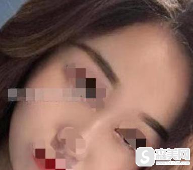 邱立东医生做脂肪填充手术怎么样?附邱立东医生真实脂肪填充案例!