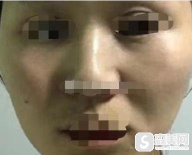 邱立东医生做脂肪填充手术怎么样?附邱立东医生真实脂肪填充案例!