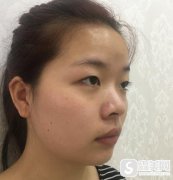 上海华美全切双眼皮恢复过程图，附案例前后照片对比＋2021整形价格浏览