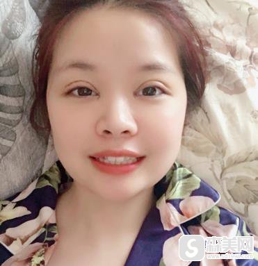 上海华美全切双眼皮恢复过程图，附案例前后照片对比＋2021整形价格浏览