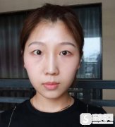 上海九院微创双眼皮恢复过程图，附较新价格表＋双眼皮术后注意问题