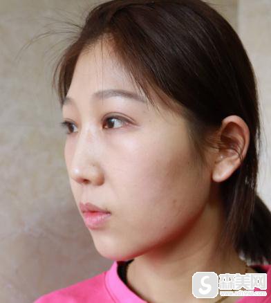 上海九院微创双眼皮恢复过程图，附较新价格表＋双眼皮术后注意问题