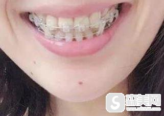 佛山爱雅口腔门诊部怎么样？附牙齿矫正案例分享+前后对比图