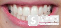 石家庄美联臣怎么样?牙齿美白果如何?附牙齿美白案例+美白前后果对比图