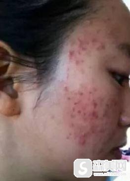 上海青浦同德医院怎么样?激光祛痘果好嘛?附前后果对比图