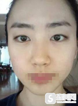 上海青浦同德医院怎么样?激光祛痘果好嘛?附前后果对比图