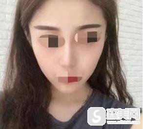 林秋蓉医生怎么样?附真实光子嫩肤案例分享及手术前后案例对比图