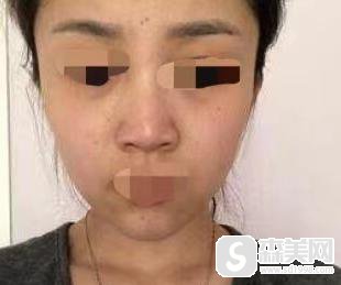 林秋蓉医生怎么样?附真实光子嫩肤案例分享及手术前后案例对比图