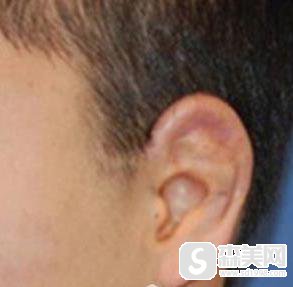 庄洪兴医生技术怎么样?附庄洪兴医生耳朵修复案例+前后对比照