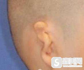 庄洪兴医生技术怎么样?附庄洪兴医生耳朵修复案例+前后对比照