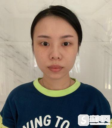 北京八大处埋线双眼皮修复前后对比，附恢复跟踪记录