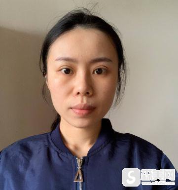 北京八大处埋线双眼皮修复前后对比，附恢复跟踪记录