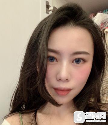 北京八大处埋线双眼皮修复前后对比，附恢复跟踪记录