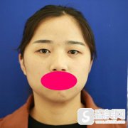 张东辉重睑手术果好不好?做完双眼皮看着自己炯炯有神的眼睛真的特别激动!