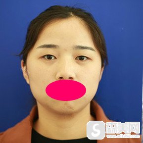 张东辉重睑手术果好不好?做完双眼皮看着自己炯炯有神的眼睛真的特别激动!