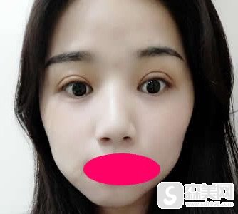 张东辉重睑手术果好不好?做完双眼皮看着自己炯炯有神的眼睛真的特别激动!