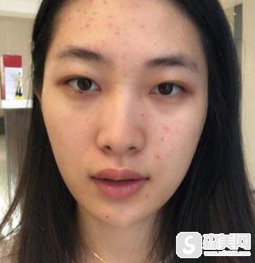 北京协和注射瘦脸整形,附亲身案例详解+注射术后注意事项