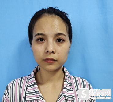 中日友好医院脂肪填充全脸，附恢复详情记录＋填充果