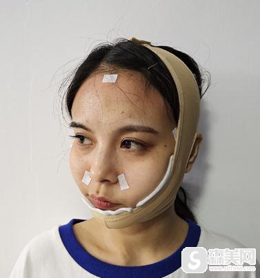 中日友好医院脂肪填充全脸，附恢复详情记录＋填充果