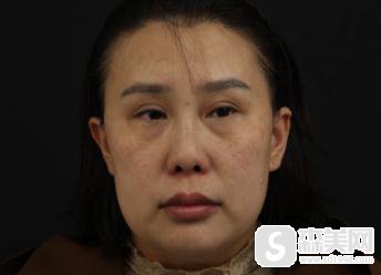 杭州时光激光祛黄褐斑的价格，附案例介绍＋较新价格表展示