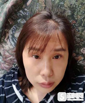 杭州时光激光祛黄褐斑的价格，附案例介绍＋较新价格表展示