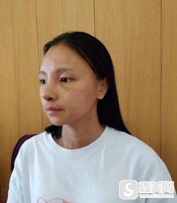 苏州美莱假体隆鼻照片，附真实案例主介＋假体隆鼻具体恢复时间