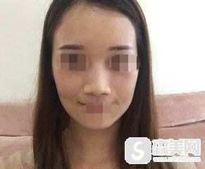 蒜头鼻整形前后对比图,蒜头鼻整形原理分享,附鼻翼缩小案例+前后对比图