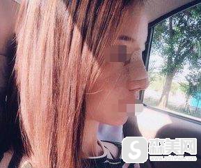 蒜头鼻整形前后对比图,蒜头鼻整形原理分享,附鼻翼缩小案例+前后对比图