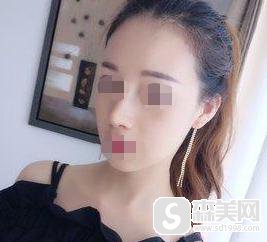 蒜头鼻整形前后对比图,蒜头鼻整形原理分享,附鼻翼缩小案例+前后对比图