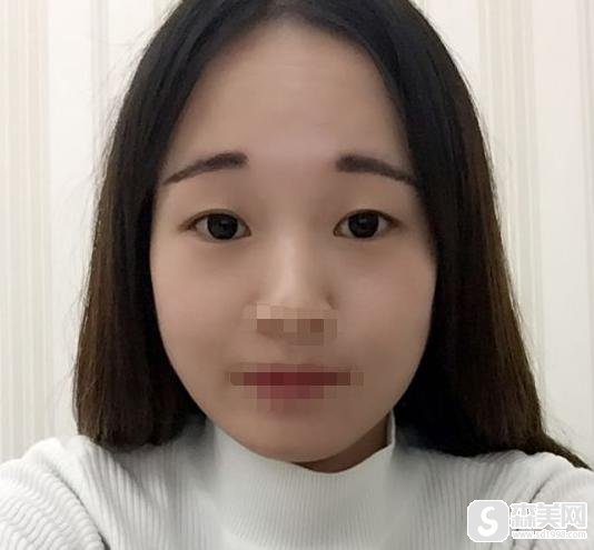 5S重睑术案例对比图，附5S双眼皮案例分享+前后果对比图