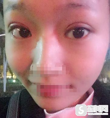 5S重睑术案例对比图，附5S双眼皮案例分享+前后果对比图