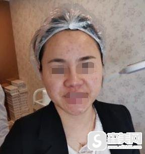 罗玲医生激光祛痘怎么样?口碑好吗?附激光祛痘案例