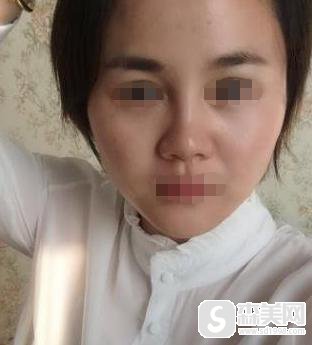 罗玲医生激光祛痘怎么样?口碑好吗?附激光祛痘案例