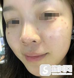 王祚轩医生做镭射净肤怎么样？专家信息介绍+内涵专家隆鼻整形案例!