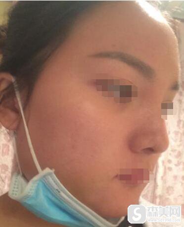 下颌角接骨整形技术怎么样？附下颌角接骨整形案例+下颌角接骨前后对比图