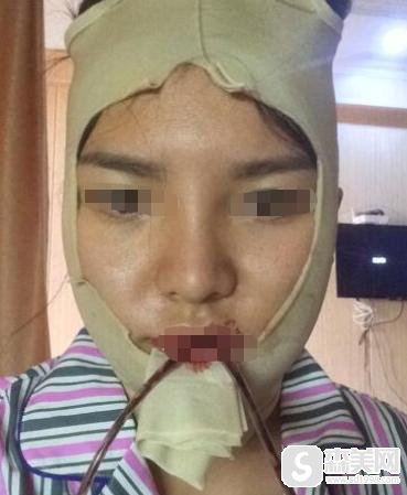 下颌角接骨整形技术怎么样？附下颌角接骨整形案例+下颌角接骨前后对比图