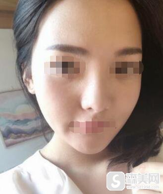 下颌角接骨整形技术怎么样？附下颌角接骨整形案例+下颌角接骨前后对比图