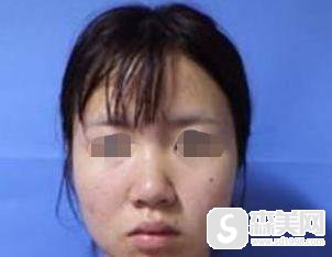 埋线提升鼻1到7天恢复过程,附埋线提升鼻案例+埋线提升鼻前后果对比