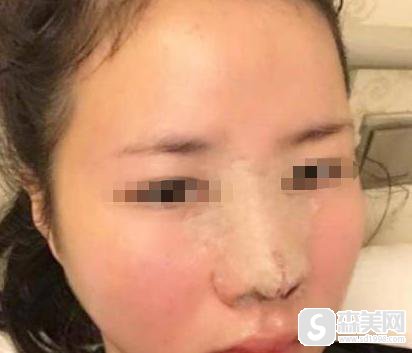 埋线提升鼻1到7天恢复过程,附埋线提升鼻案例+埋线提升鼻前后果对比