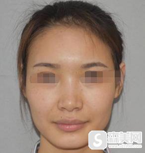 杜若溪整容了么？杜若溪整容揭秘,附真实隆鼻案例+隆鼻前后案例果图